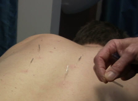 japanese acupuncture uses