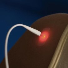 Laser Light Needle Therapy